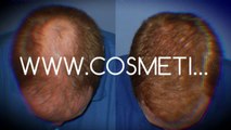 scalp med - shampoo for hair loss - thinning hair - Dr. Ari Chennai - Dr. Ari Arumugam - Cosmetic Surgery Chennai