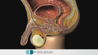 What is Urethritis? by St Pete Urology