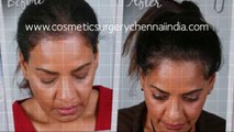 vitamins for hair loss - alopecia - alopecia areata - Dr. Ari Arumugam - Plastic Surgery Chennai - Dr. Ari Chennai