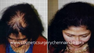 hair growth products - hair growth shampoo - hair implants - Dr. Ari Arumugam - Plastic Surgery Chennai - Dr. Ari Chennai