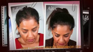 baldness - female hair loss - fue hair transplant - Dr. Ari Chennai - Dr. Ari Arumugam - hair Loss Treatment Chennai