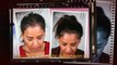 how to stop hair loss - laser comb - male pattern baldness - Dr. Ari Arumugam - Cosmetic Surgery Chennai - Dr. Ari Chennai