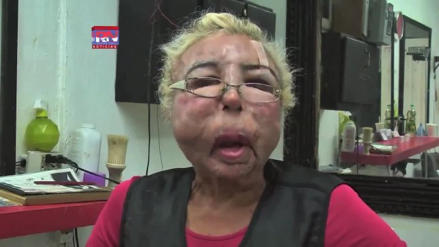 Défiguré par des injections au visage d'huile pour bébé