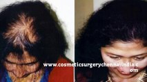 thinning hair - thinning hair women - tips for hair growth - Cosmetic Surgery Chennai - Dr. Ari Chennai - Dr. Ari Arumugam