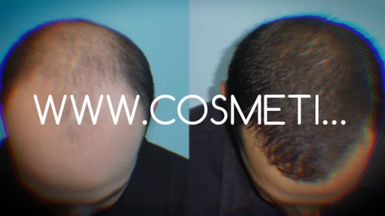 hair growth shampoo - hair implants - hair loss - Dr. Ari Chennai - Dr. Ari Arumugam - Cosmetic Surgery Chennai