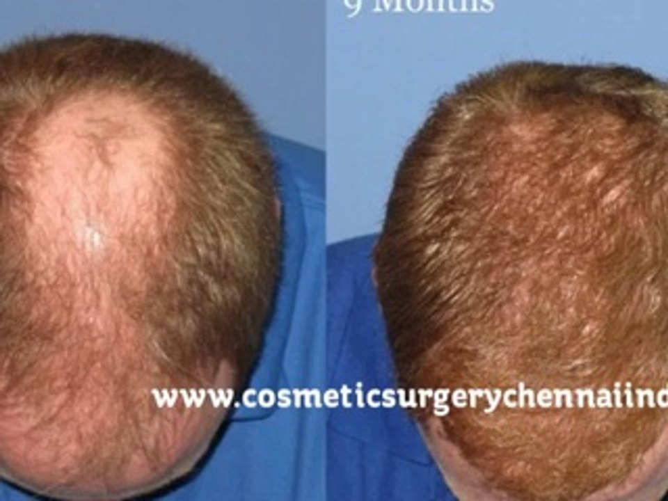 how to reduce hair fall - how to stop hair fall - how to stop hair loss - Dr. Ari Arumugam - Cosmetic Surgery Chennai - Dr. Ari Chennai