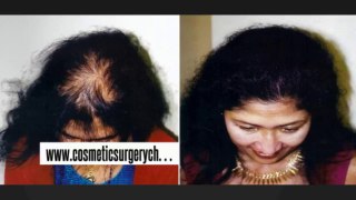 fue hair transplant - hair fall - hair fall solution - Dr. Ari Arumugam - Cosmetic Surgery Chennai - Dr. Ari Chennai