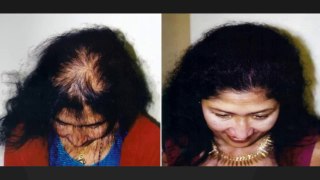 hair implants - hair loss - hair loss causes - Dr. Ari Chennai - Dr. Ari Arumugam - hair Transplant Chennai