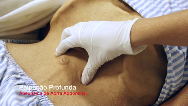 Aneurisma de Aorta Abdominal - Inspeção e Palpação