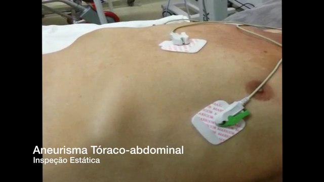 Aneurisma Toracoabdominal - Inspeção