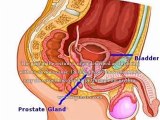 Enlarged Prostate Rectal Discomfort - What Is The Link Between Enlarged Prostate And Rectal Discomfort