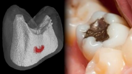 No More Drill! Electrical Currents Could Heal Cavities