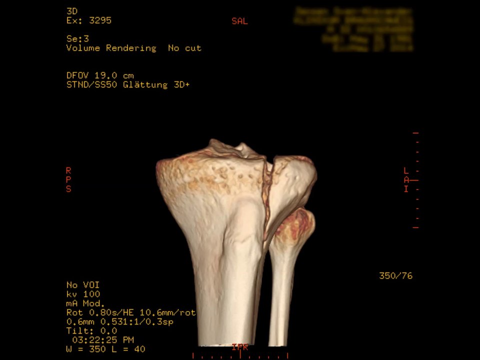 Meine Tibiakopffraktur