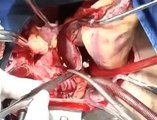 Heart Transplantation