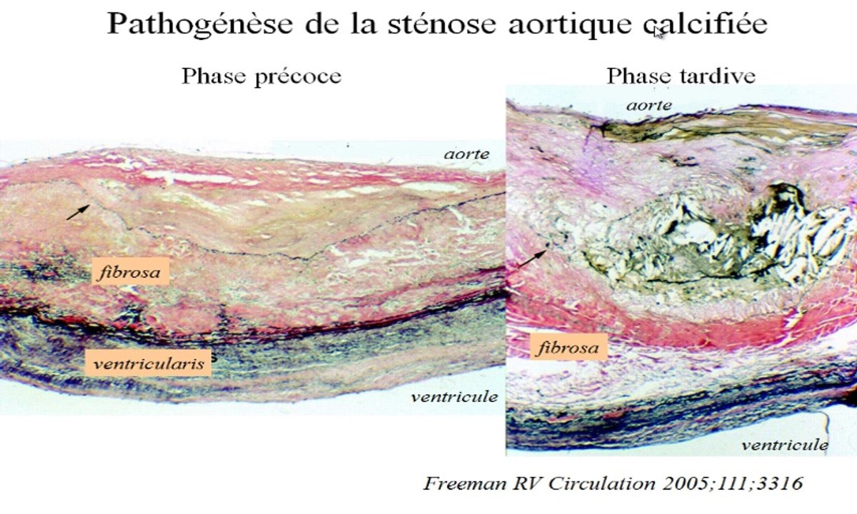 Diabete et Valvulpathies. Pr Jean Acar