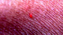 Flesh Eating Bug Ate my Skin - Bizarre Bloodcurdling attack-