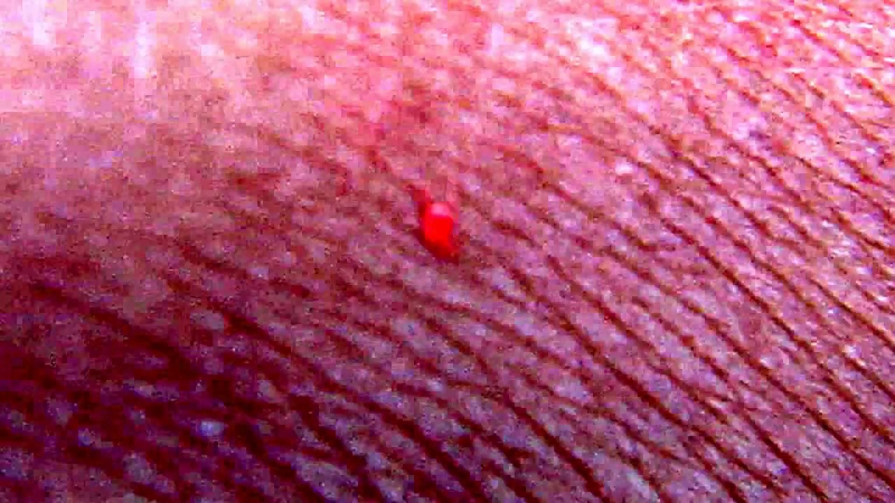 Flesh Eating Bug Ate my Skin - Bizarre Bloodcurdling attack-