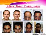 FUE Hair Transplant in India