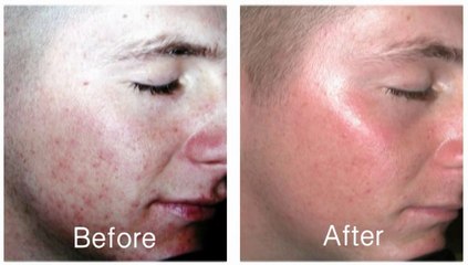 Comedon Extraction by Elixir