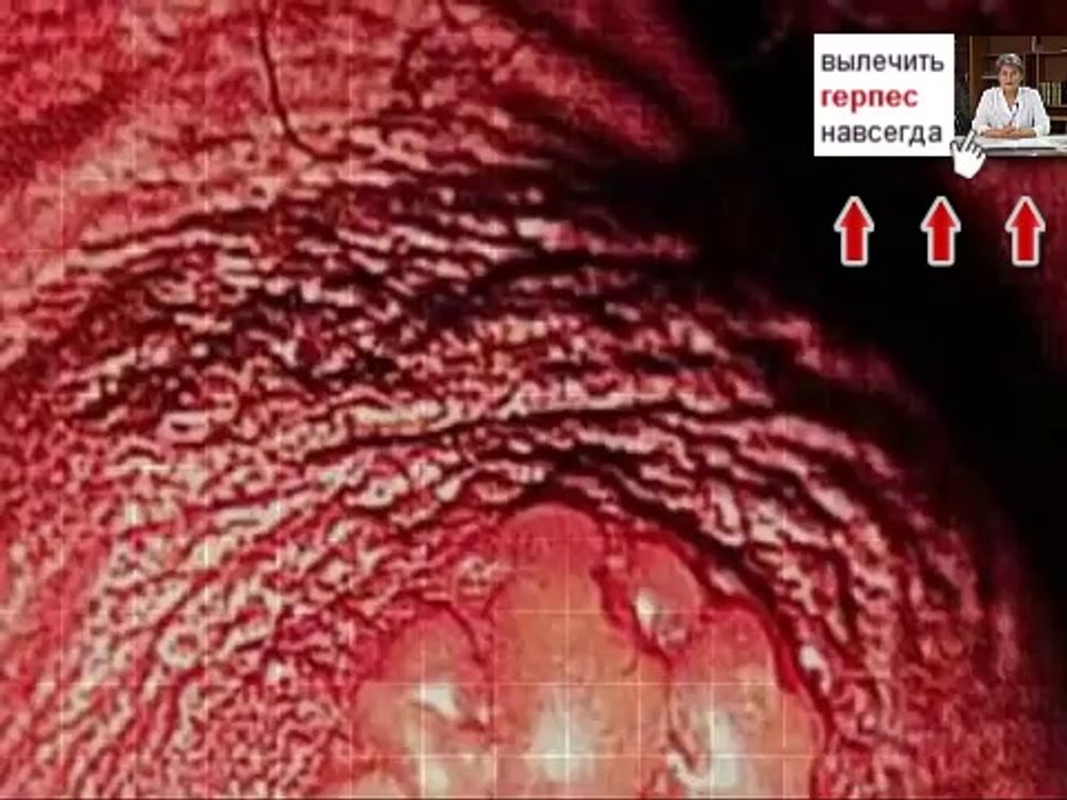 Герпес на пололовых органах фото  Как лечить пололовой герпес