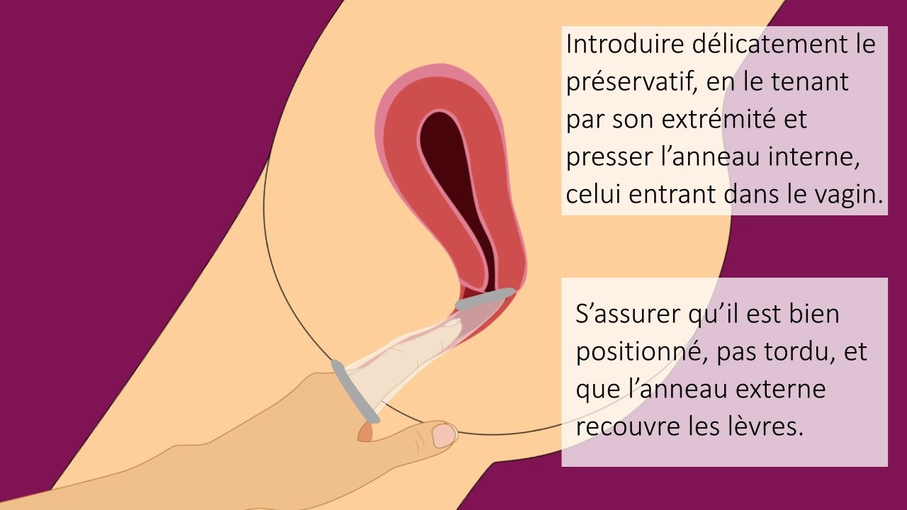 Préservatif féminin : mode d'emploi