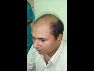 Follicular unit extraction in  Pakistan www.fuepakistan.com