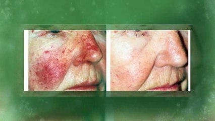 Acne Laser Treatment