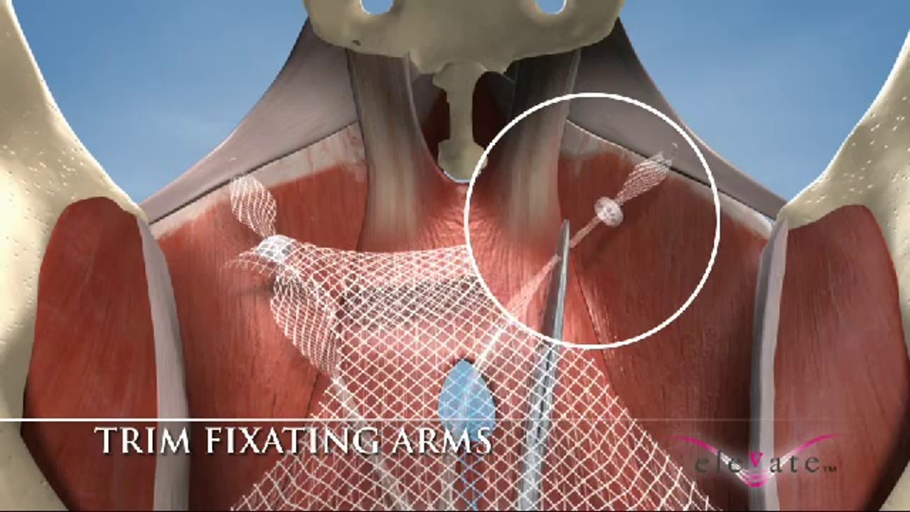 AMS Elevate Anterior Animation