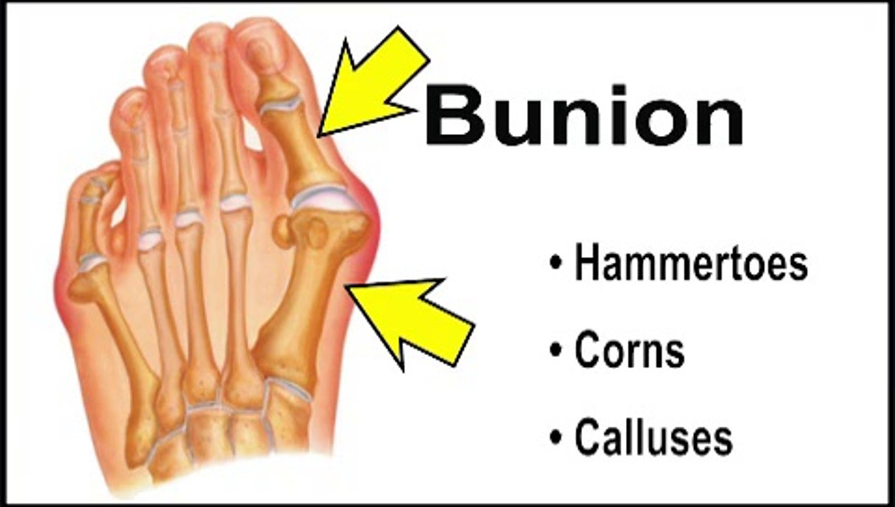 Buffalo Grove, Hinsdale, Sycamore, IL - Bunions - Podiatrist Neil  Levin