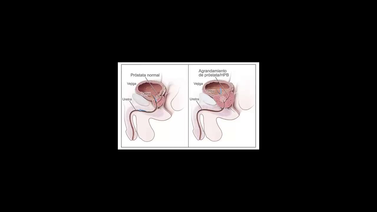 Prostata