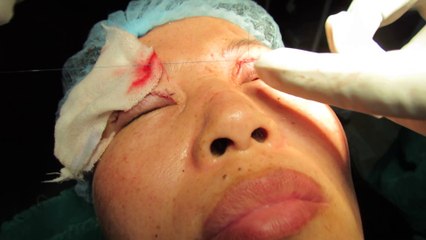 Double Eyelid Surgery Cost in India