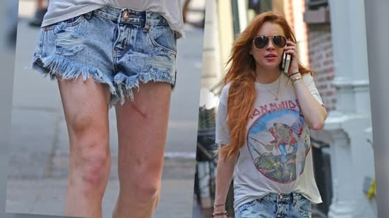 Lindsay Lohan Blames Leg Abrasions on Citi Bike Accident