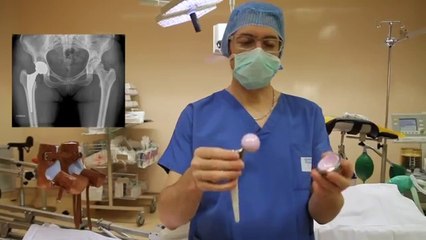 Prothèse totale de hanche
