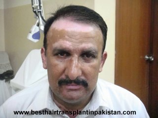 follicular unit extraction in pakistan www.fuepakistan.com