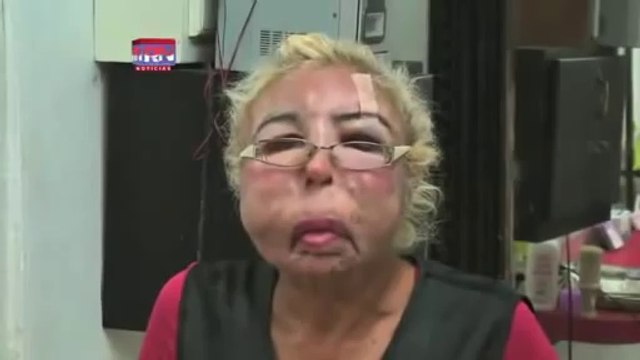 Il est défiguré après s'être fait injecter de l'huile pour bébé