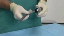 Protesi d'Anca: la soluzione per la coxartrosi
