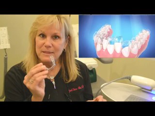 iTero Scanner - Invisalign NY Orthodontist
