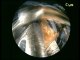 Kapalı Böbrek Taşı Ameliyatı (PNL) - Perkütan Nefrolitotomi | Op. Dr. Cüneyd Sevinç