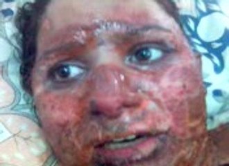 burnt victim Shehnaz Raheem(late)waiting for Insaaf..