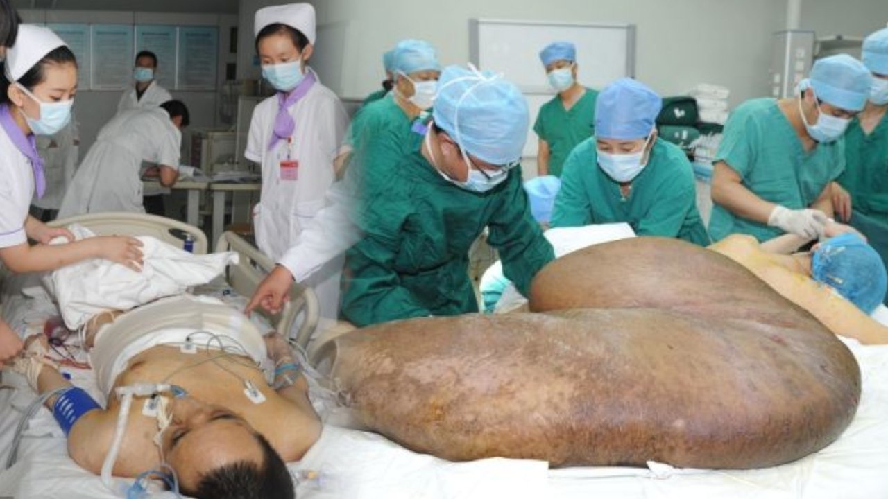 Surgeons Remove 240lb Tumor from Man's Back
