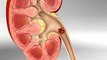 How Do Kidney Stones Form?  How Can We Prevent Them