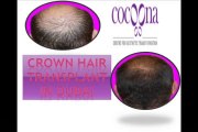 Hair Transplantation in Dubai