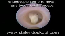 Sialendoscopy in salivary gland stones