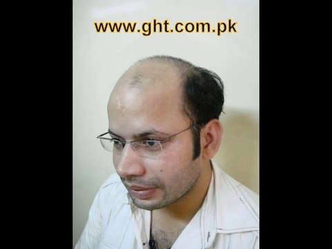 Best FUE Hair Transplant Clinic and Doctor in Pakistan - fuepakistan.com