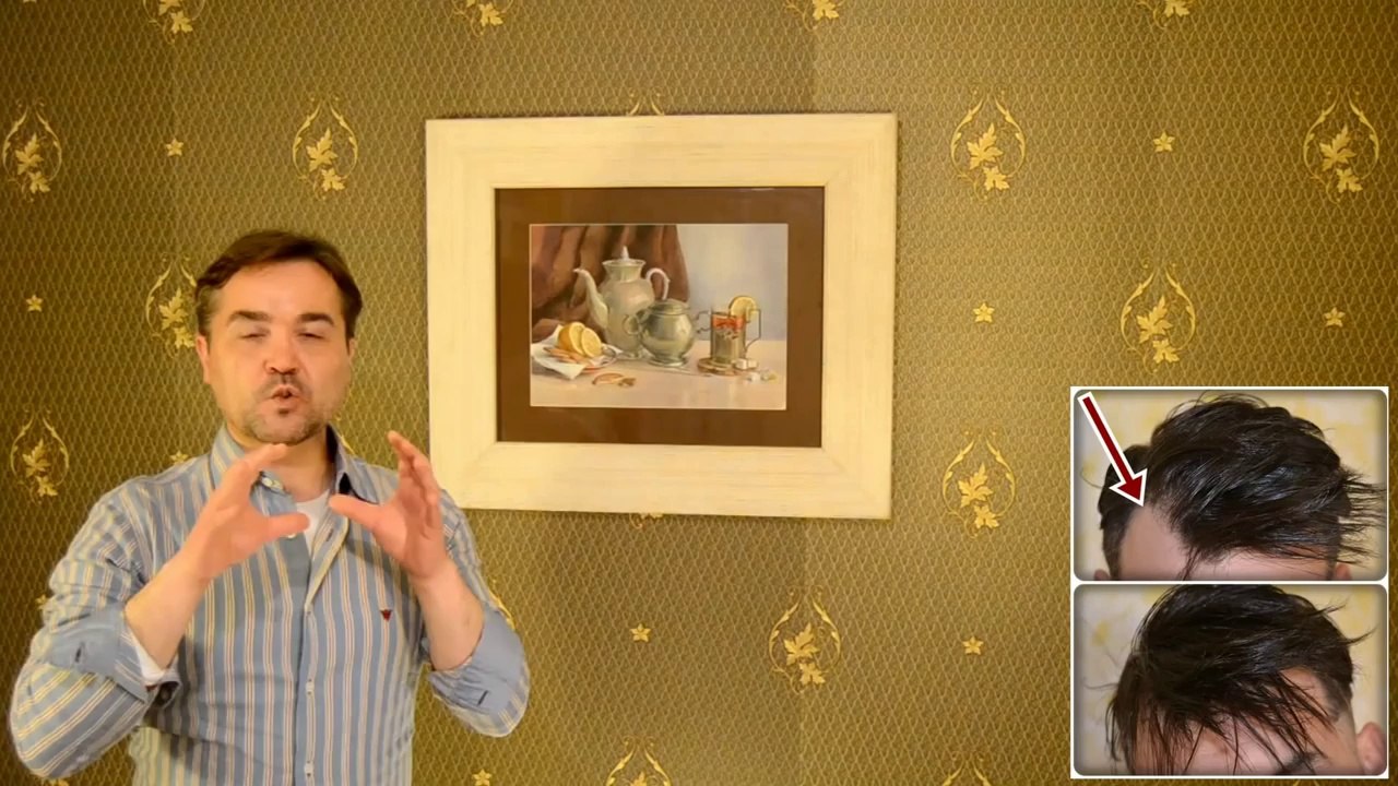 Cómo peinarse si tienes entradas. Tengo entradas. Peinarte teniendo entradas. Alopecia - Calvicie