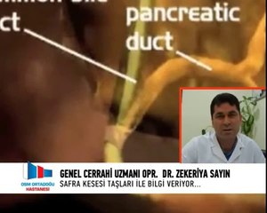 Safra Kesesi Taşlarının Belirtileri Nelerdir, Nasıl Tedavi Edilir?