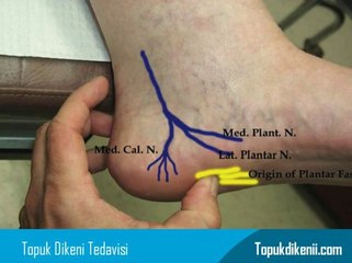 Topuk Dikeni Olanlar Nasıl Ayakkabı Giymeli