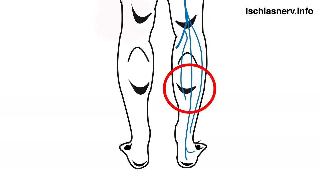 Lumboischialgie, ischiasnerv