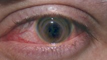 Girl's Eyes EATEN by Amoebas After Prolonged Contact Use