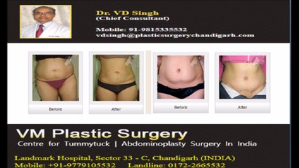 Tummytuck in Chandigarh, Punjab, India